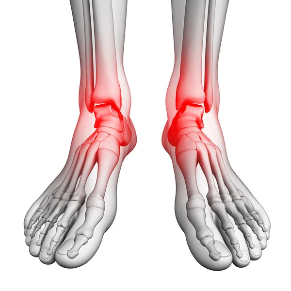 Foot pain artwork — Stock Photo, Image