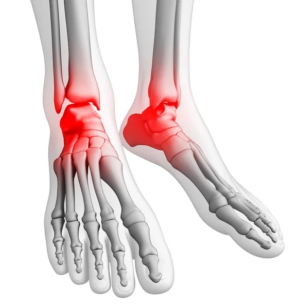 足の痛みのアートワーク — ストック写真