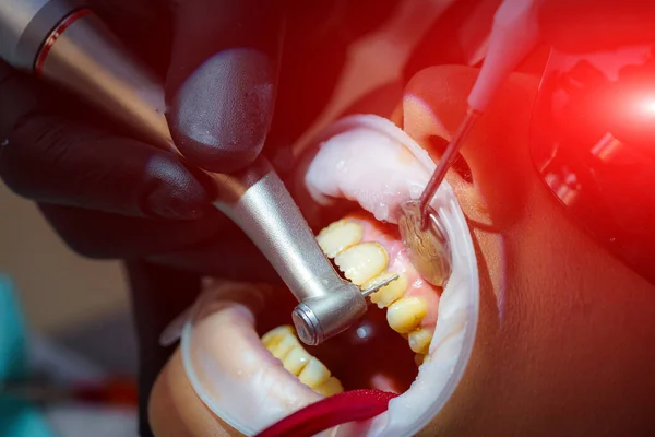 Zahnärzte Überprüfen Und Reparieren Den Zahn Einer Jungen Patientin Schutzbrille — Stockfoto