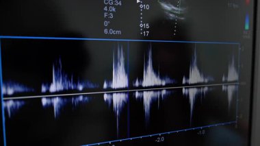 Doppler echocardiography waveform. Ultrasound monitor shows blood flow velocity graph during Doppler heart examination.