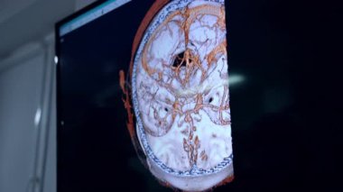 Kafanın MRI görüntüsü yukarıdan. Beyin taraması nörocerrahi için. Kapat..