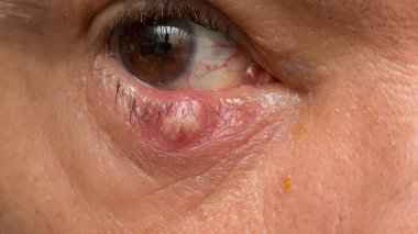 Göz kapağında kocaman bir taş olan bir adam. 