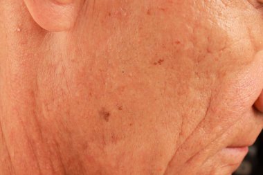 Mature man with age spots or liver spots on the side of his face likely cause from sun exposure