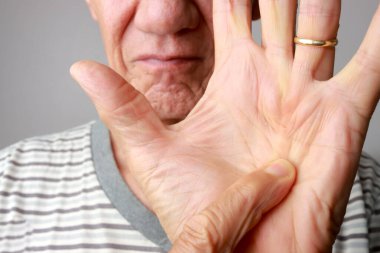 Kıdemli adam avucunun içinde Dupuytren Kasılmalarını gösteriyor.