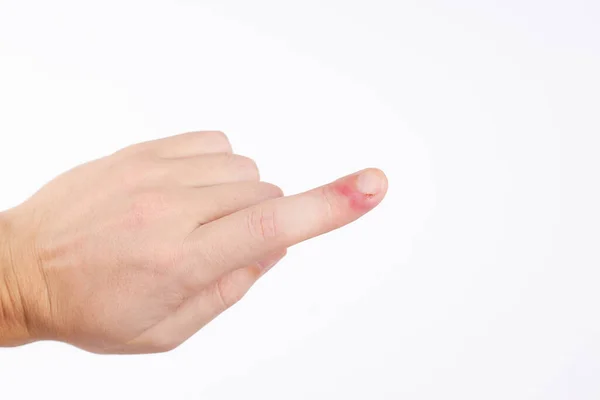 Person with finger infection disease. fingernail pain. isolated on white background. copy space — Stock Photo, Image