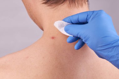 Cilt sorunları olan beyaz bir erkek. Sivilce kontrolü. cilt bakımı kavramı