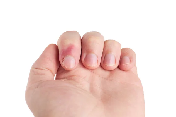 Людина з інфекційними захворюваннями пальців. біль у нігтях. ізольовані на білому тлі. копіювання простору — стокове фото