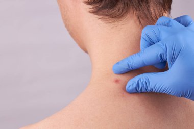 Cilt sorunları olan beyaz bir erkek. Sivilce kontrolü. cilt bakımı kavramı