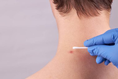 Cilt sorunları olan beyaz bir erkek. Sivilce kontrolü. cilt bakımı kavramı