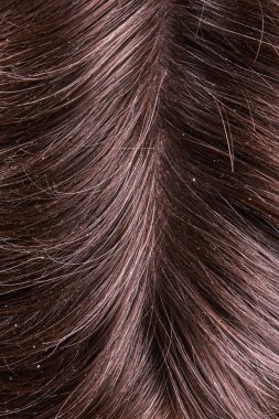 Kepek hastalığı olan bir erkek. dermatoloji sağlık hizmetleri