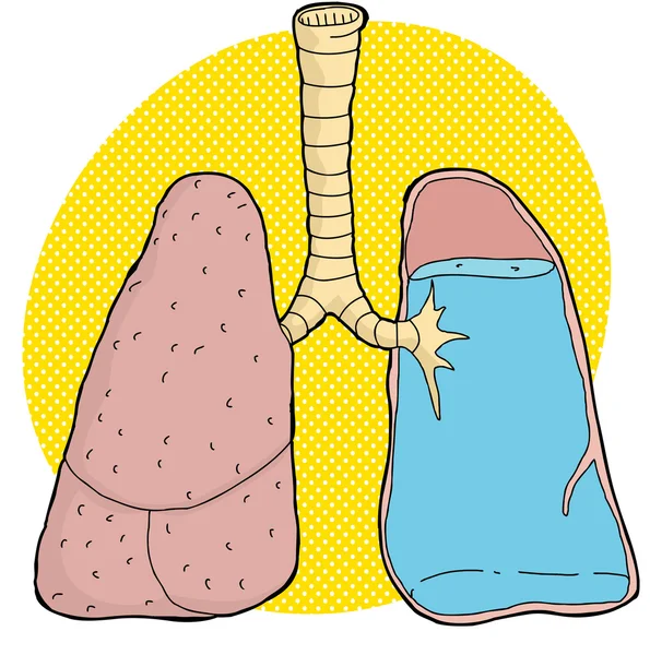 Illustration einer Lungenentzündung — Stockvektor