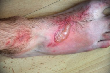 Fitofotodermatit, Kutanöz Fototoksik deri inflamatuvar eru