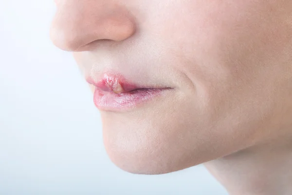 Hermoso virus de los labios infectados herpes — Foto de Stock