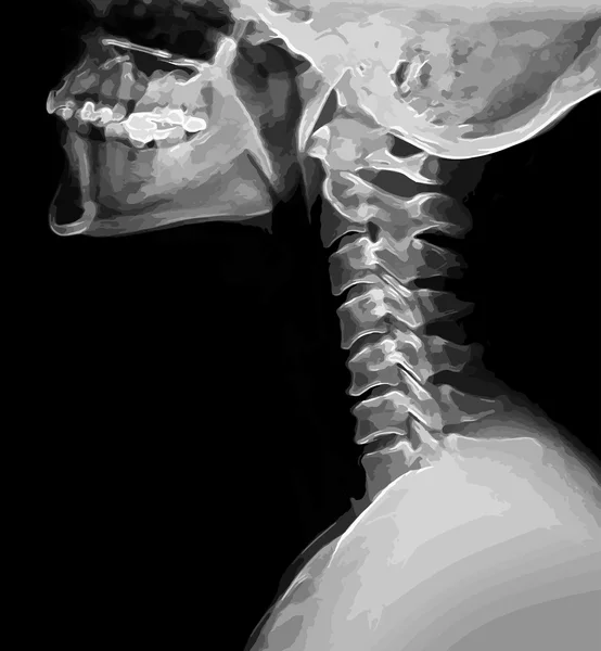 Imagen de rayos X de la columna cervical y la cabeza, en blanco y negro — Vector de stock