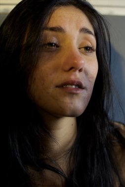 Kadın sokakta şiddet sonra yüzüne morluklar ile