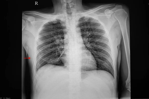 Radiografía Tórax Que Muestra Neumotórax Pequeño Lado Derecho Del Pulmón — Foto de Stock