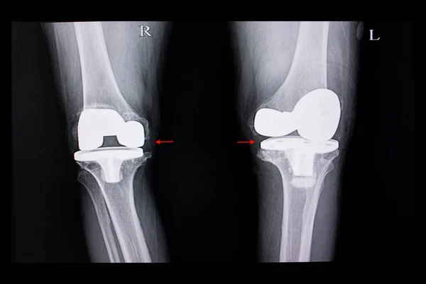 Ray Film Van Een Patiënt Met Beide Knieën Geleedpokkenoperatie — Stockfoto