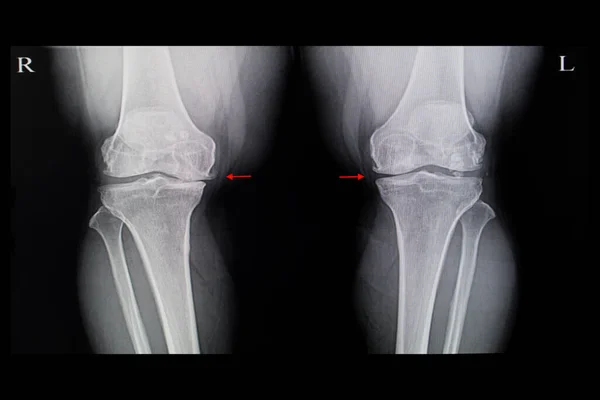 Pellicola Raggi Paziente Con Entrambe Ginocchia Osteoartrite Degenerativa Con Speroni — Foto Stock