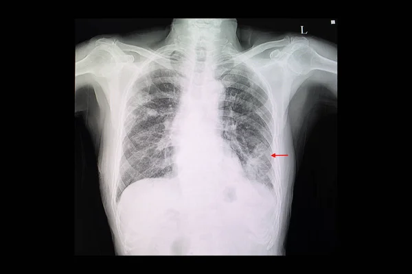 左下肺肺炎及び右上肺結節を有する患者の胸部X線フィルム — ストック写真