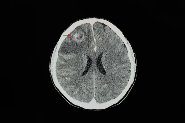 Una Tomografía Computarizada Cerebral Con Contraste Paciente Con Lesión Que — Foto de Stock