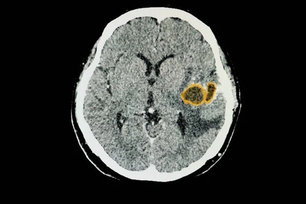Sol Temporal Lobunda Büyük Beyin Apsesi Olan Bir Hastanın Tomografisi — Stok fotoğraf