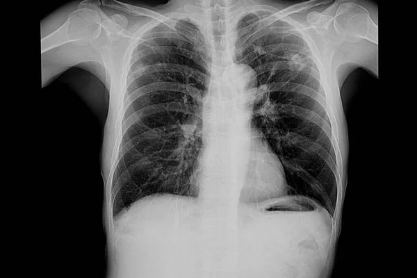 Film Radiographique Patient Atteint Tuberculose Pulmonaire Dans Les Deux Poumons — Photo