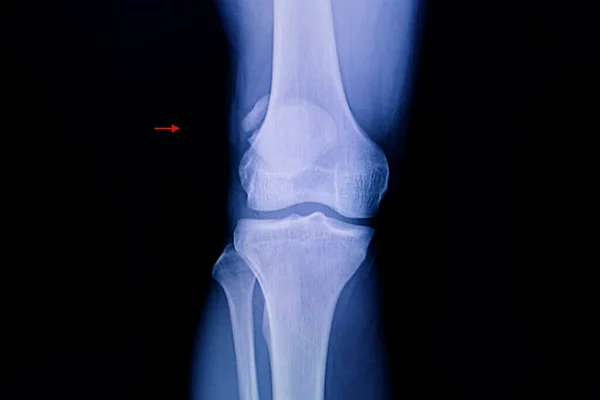 Колінна Рентгенографія Пацієнта Показує Дводольний Пастель — стокове фото