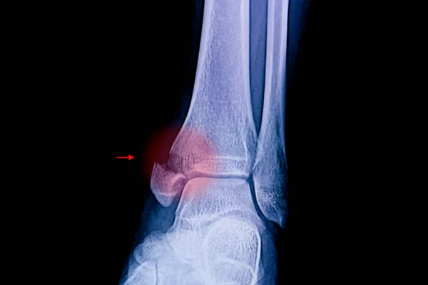 Рентгенівська Плівка Щиколотки Пацієнта Показує Медіальний Малельозний Перелом — стокове фото