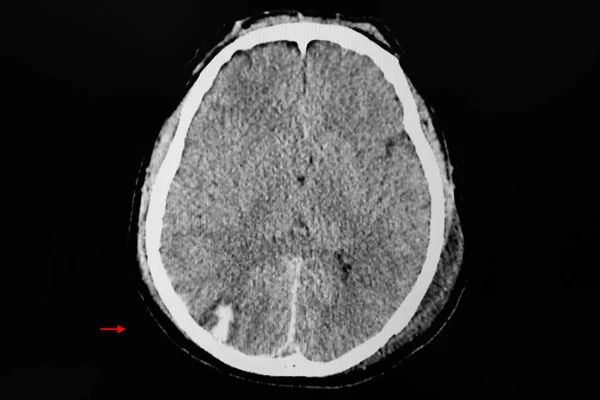 Kafa Yaralanması Geçiren Bir Hastanın Beyin Tomografisi Sağ Oksipital Lobunda — Stok fotoğraf