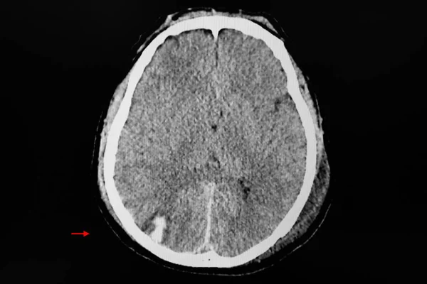 부상을 후두엽에서 출혈성 타박상을 있습니다 — 스톡 사진