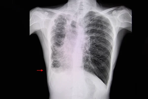 Radiografía Tórax Paciente Con Bronquiectasias Con Derrame Pleural Parcial Derrumbado — Foto de Stock