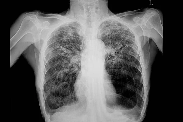 Chest xray of of patient with emphysematous lungs, hilar adenopathy, and granulomatous changes of both upper lungs.
