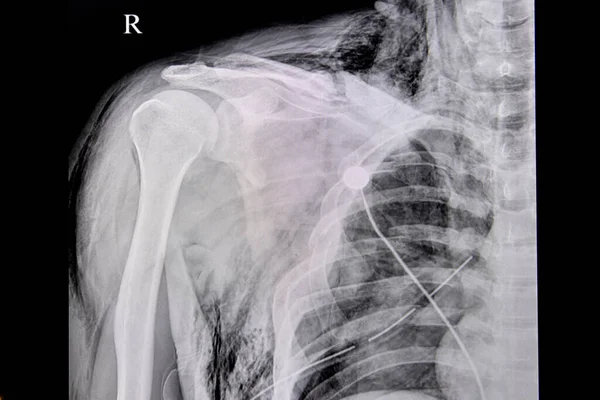 右鎖骨骨折の患者の胸部X線フィルム 肋骨2番目から7番目 皮下肺気腫 組織内の空気漏れ 胸部ドレン管も見られます — ストック写真