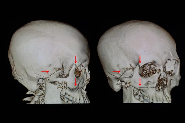 右側の時間的 軌道的 および上顎骨を含む複数の顔と頭蓋骨の骨折を有する患者の頭蓋骨の3Dレンダリングスキャン — ストック写真