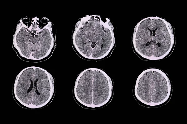 侧脑室性脑膜炎链球菌 Streptococcus Suis Meningitis 患者的Ct脑扫描显示 双侧顶叶皮质沟的脑膜增强 他的脑脊液显示许多中性粒细胞具有培养能力 — 图库照片