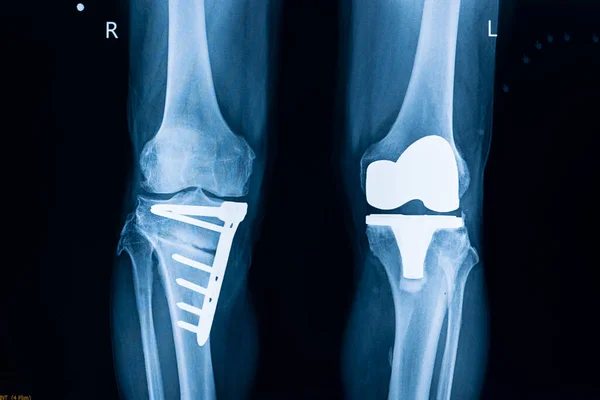 Radiografía Paciente Tras Cirugía Total Reemplazo Rodilla Izquierda Fijación Placa — Foto de Stock