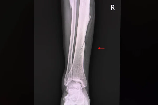 X-ray film of a patient with closed non displaced spiral fracture of right tibia (lower leg bone).