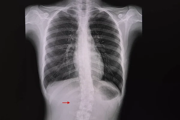 광대뼈 가시의 대장균 Xray — 스톡 사진