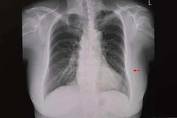 Chest Xray Patient Showing Small Plate Atelectasis Left Lung — 스톡 사진