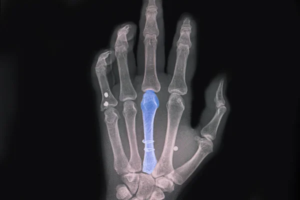 Hand xray showing spiral fractured third metacarpal bone after surgical fixation with two circular wires.