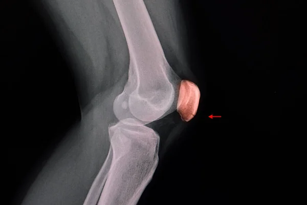 Knie Röntgenfoto Van Een Patiënt Met Een Glanzende Lijn Aan — Stockfoto