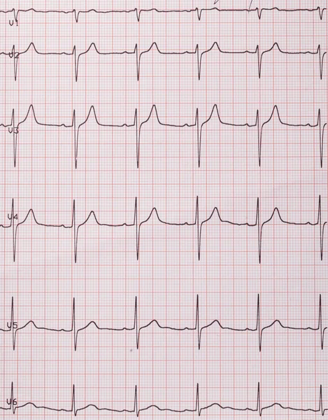 Hart klopt cardiogram — Stockfoto