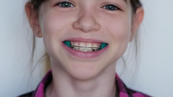 Petite, jeune fille souriante porte un appareil dentaire orthodontique, retenue, bretelles. — Video