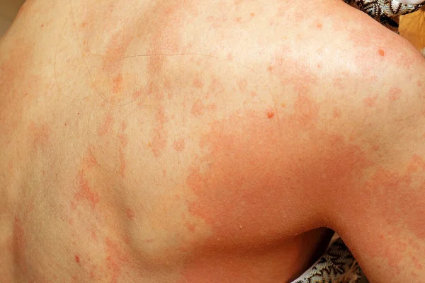Ernstige Rode Vlekken Allergie Rug Lichaam Huid — Stockfoto