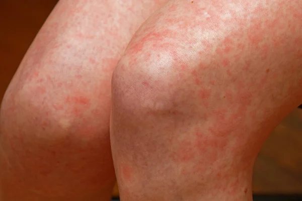 Egzama Dermatiti Diğer Tıbbi Durumlar Sırasında Insan Derisinde Kırmızı Noktalar — Stok fotoğraf