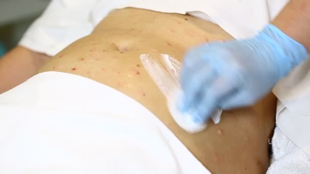 Vrouw is in het proces cellulitis — Stockvideo