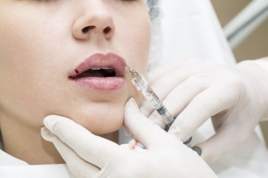 Kontur plastik dudaklar