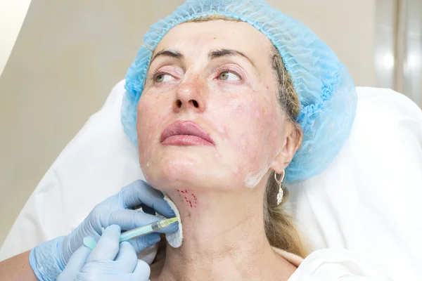 Cosmetic treatment with injection — Stock Photo, Image