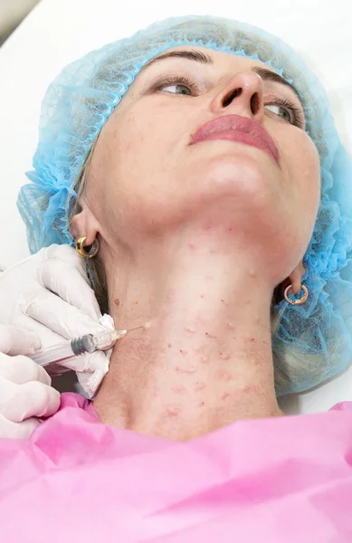 Cosmetic treatment with botox injection — Stock Photo, Image