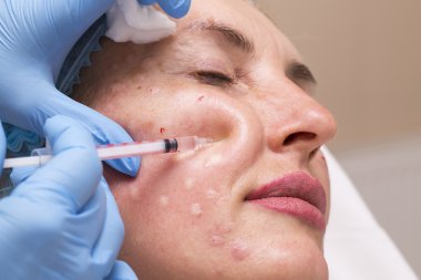 kozmetik tedavisi botox enjeksiyonu ile